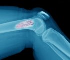 4. evre osteosarkom (kemik kanseri) tedavisinde regorafenib ile dikkat çeken sonuçlar