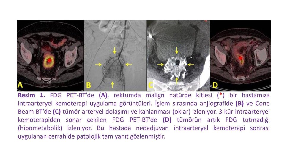 Rektum-kanserinde-intraarteryel-kemoterapi-sonuclarimiz