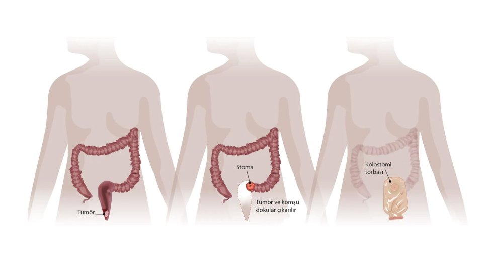 Could Permanent Colostomy Be Avoided in Rectal Cancer?