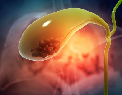 Safra Taşları Pankreas Kanserinin Habercisi Olabilir