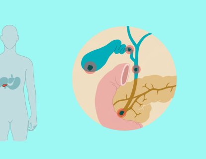Safra Yolu Darlığı ve Genişlemesi Nedir? Pankreas Kanserinin Bir Erken Uyarısı mıdır?