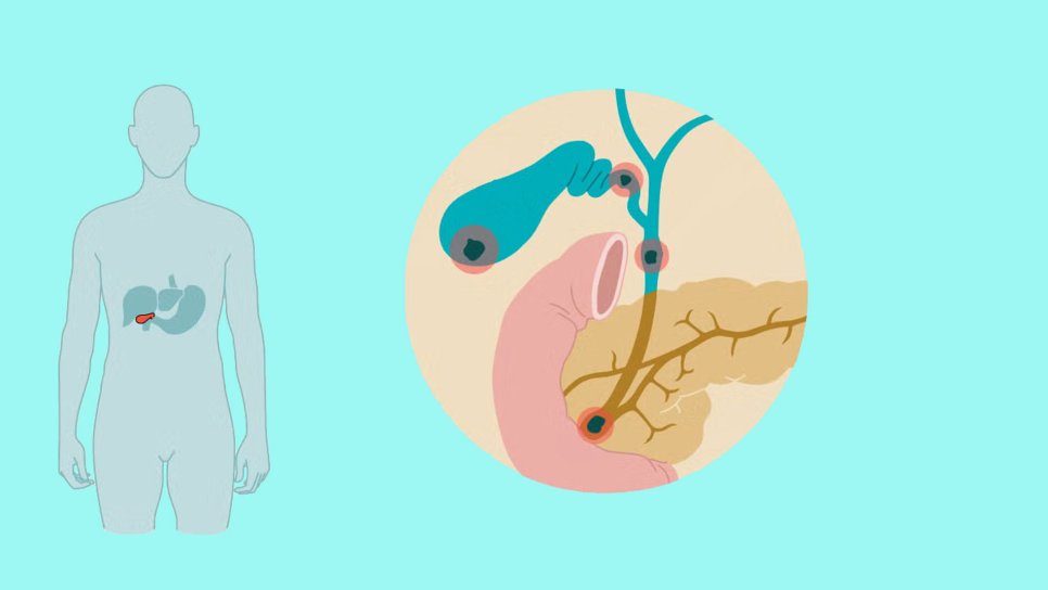 Safra Yolu Darlığı ve Genişlemesi Nedir? Pankreas Kanserinin Bir Erken Uyarısı mıdır?