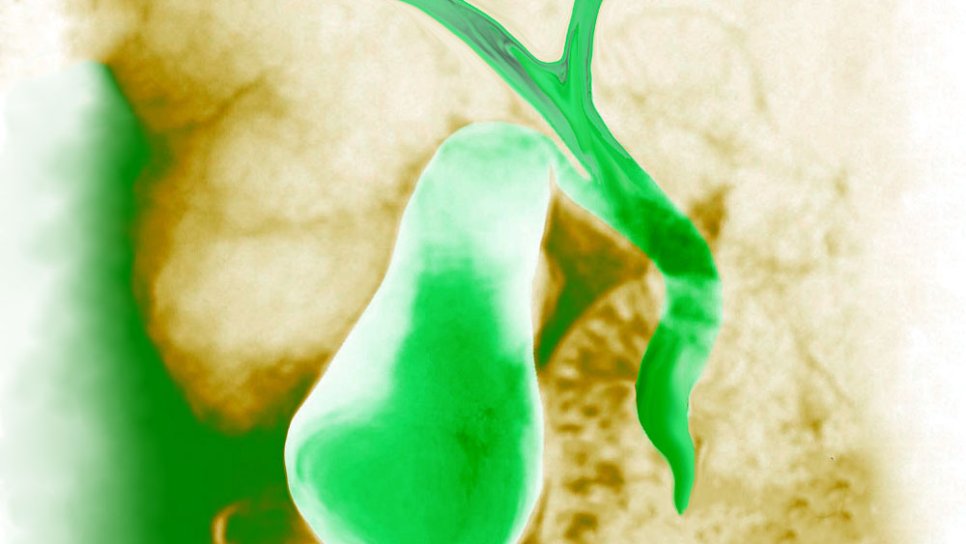 Adding Durvalumab Immunotherapy to Chemotherapy Improves Survival in Biliary Tract Cancer