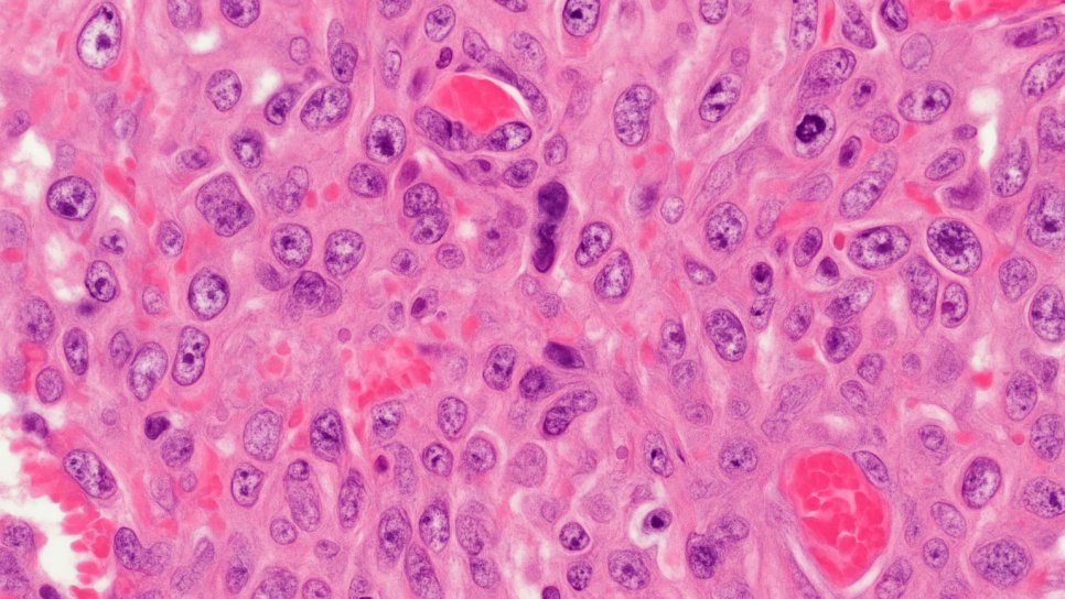 Was sagen Histopathologie, Immunhistochemie und Molekulardiagnostik gemeinsam über die Sarkomdiagnose aus?