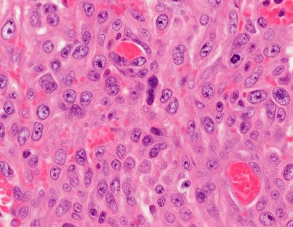 Sarkom Tanısında Histopatoloji, İmmünohistokimya ve Moleküler Tanı Birlikte Ne Anlatıyor?