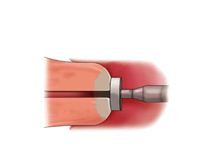 Servikal Kriyoterapi (Rahim Ağzı Dondurma Tedavisi) Nedir?