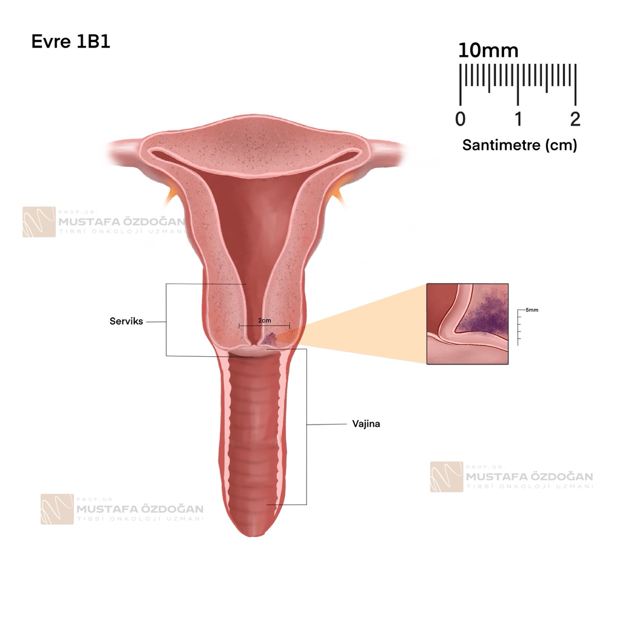 serviks kanseri evre 1b1 157341