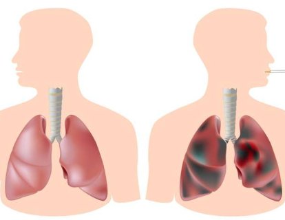 Sigarayı bırakmak, sağlıklı akciğer hücrelerinin çoğalmasını sağlıyor
