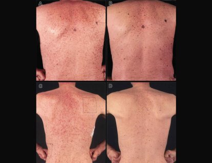 Sistemik Mastositoz Tedavisi için Avapritinib FDA Onayı Aldı