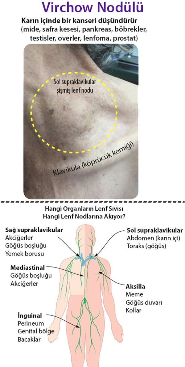 sol supraklavikular lenf nodu virchow nodu 968587