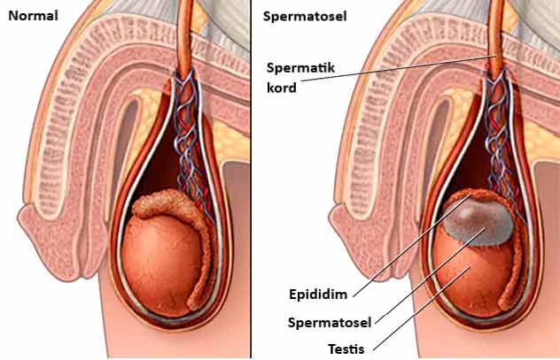 spermatosel nedir 315696