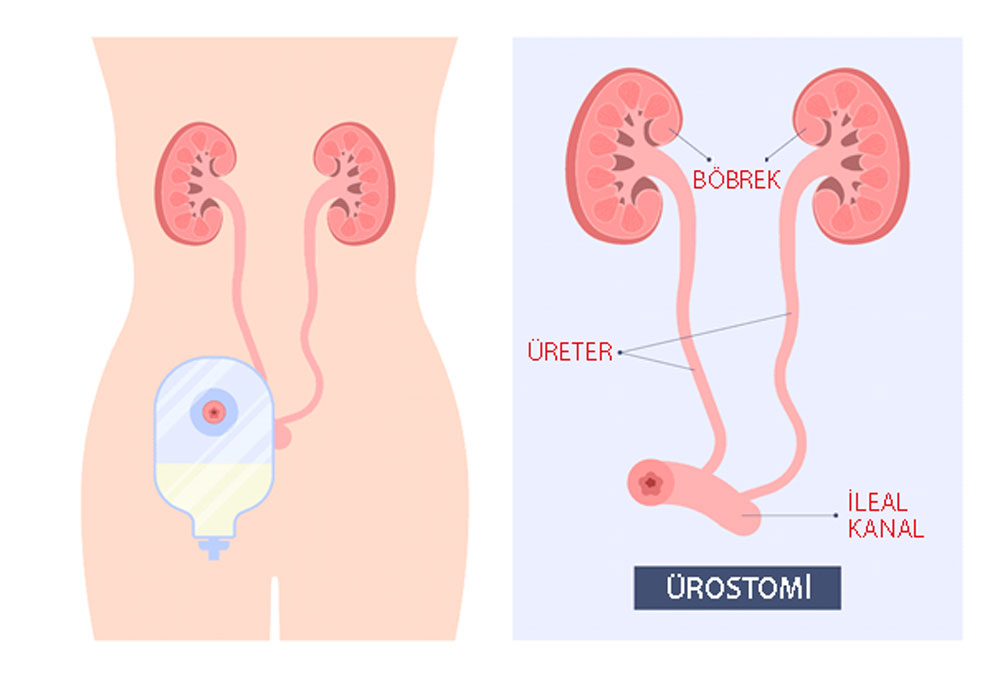 standart urostomi nedir inkontian diversiyon vucudun disinda toplanan idrarla kesintisiz akis 82462
