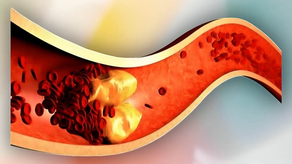 Statins 1973 – The Discovery of Cholesterol Drugs
