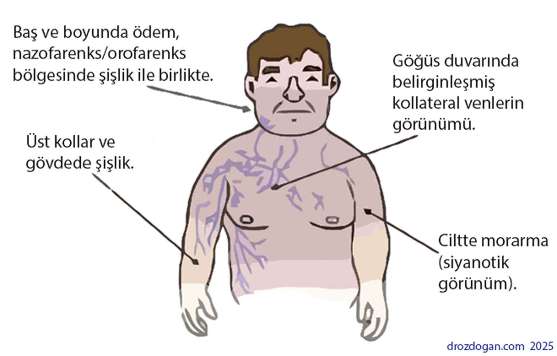 What are the symptoms of superior vena cava syndrome (SVCS)? An oncological emergency