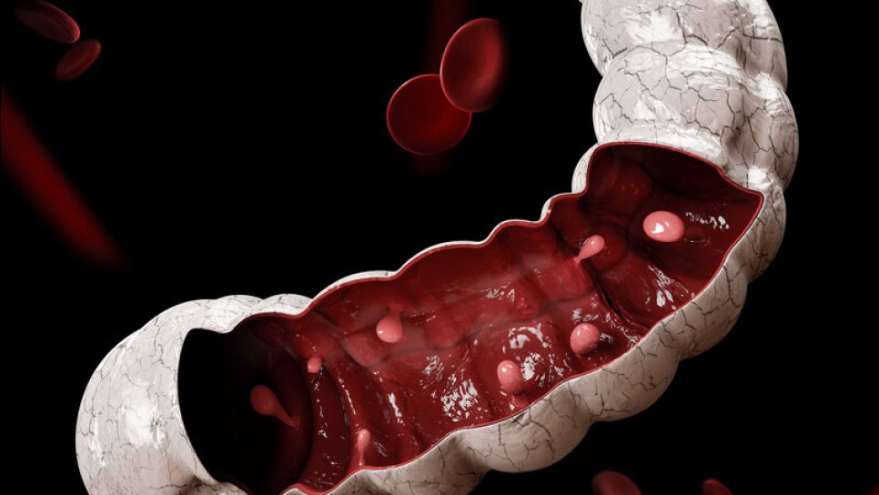 Incompletely Removed Colon and Rectal Polyps Often Recur