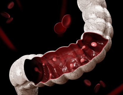 Tam çıkarılmayan kolon ve rektum polipleri sıklıkla tekrarlar