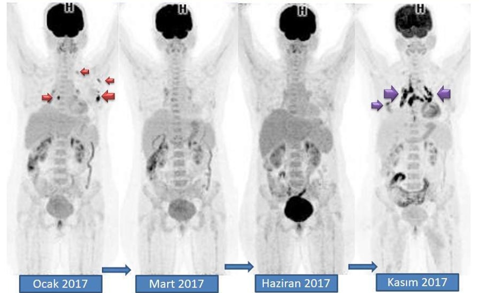 tedavi yanitini olcmede en etkili goruntuleme yontemi pet ct 850957