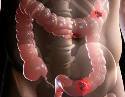 Tedaviye Dirençli 4. Evre Kolorektal Kanser için Yeni Bir Akıllı İlaç: Fruquintinib