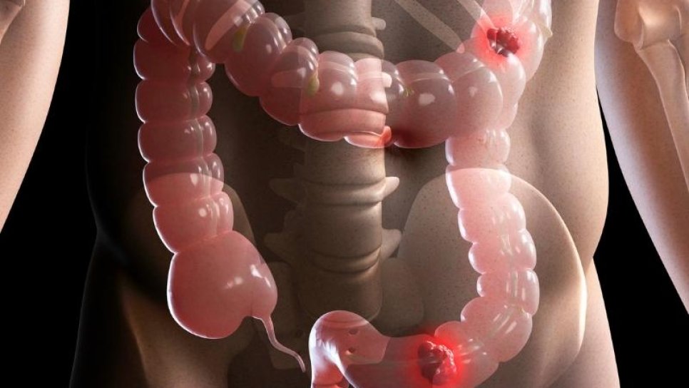 Tedaviye Dirençli 4. Evre Kolorektal Kanser için Yeni Bir Akıllı İlaç: Fruquintinib