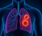 Telisotuzumab vedotin (Emrelis) Nedir? FDA Onayı, Türkiye Ruhsatı ve Geri Ödeme Durumu
