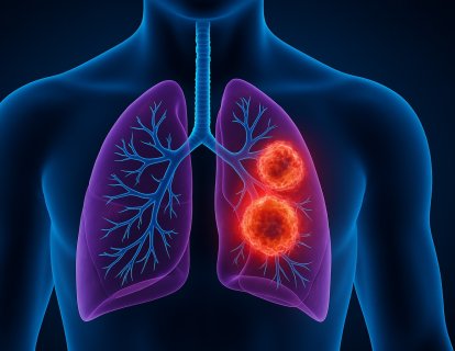 Telisotuzumab vedotin (Emrelis) Nedir? FDA Onayı, Türkiye Ruhsatı ve Geri Ödeme Durumu
