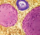 Teratom Nedir? Belirtileri, Nedenleri ve Tedavisi