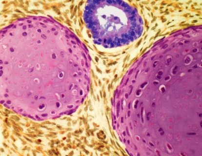 Teratom Nedir? Belirtileri, Nedenleri ve Tedavisi