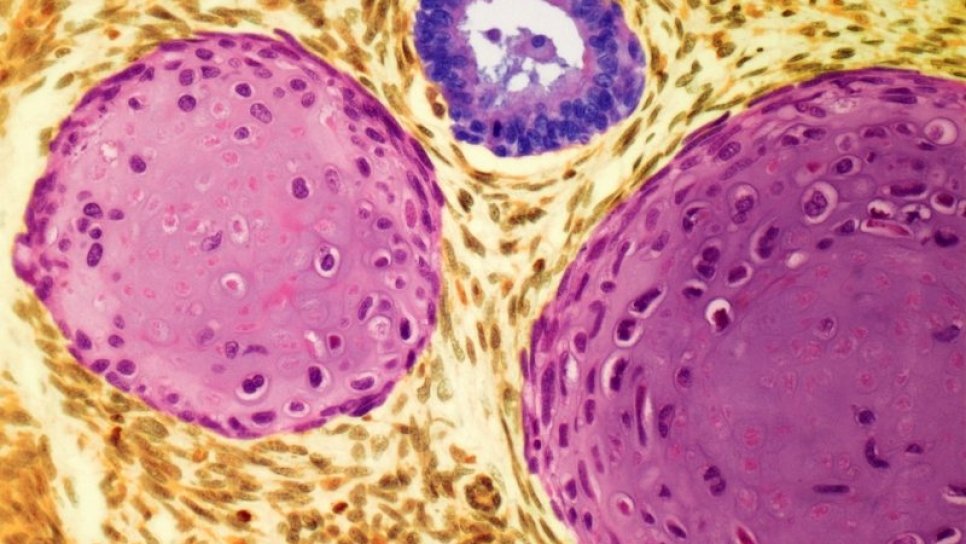 Teratom Nedir? Belirtileri, Nedenleri ve Tedavisi