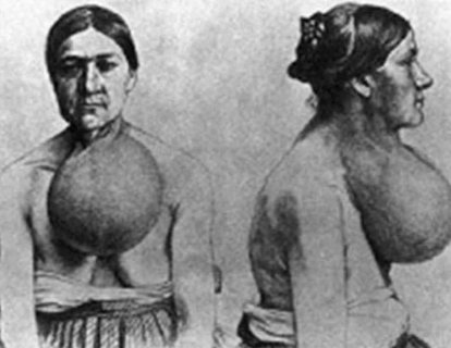 Tiroid Ameliyatı 1872 – Nobel Fizyoloji Ödülü 1909