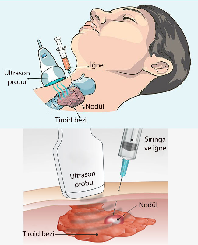 tiroid ince igne aspirasyon biyopsisi iiab nasil yapilir nedir 934105