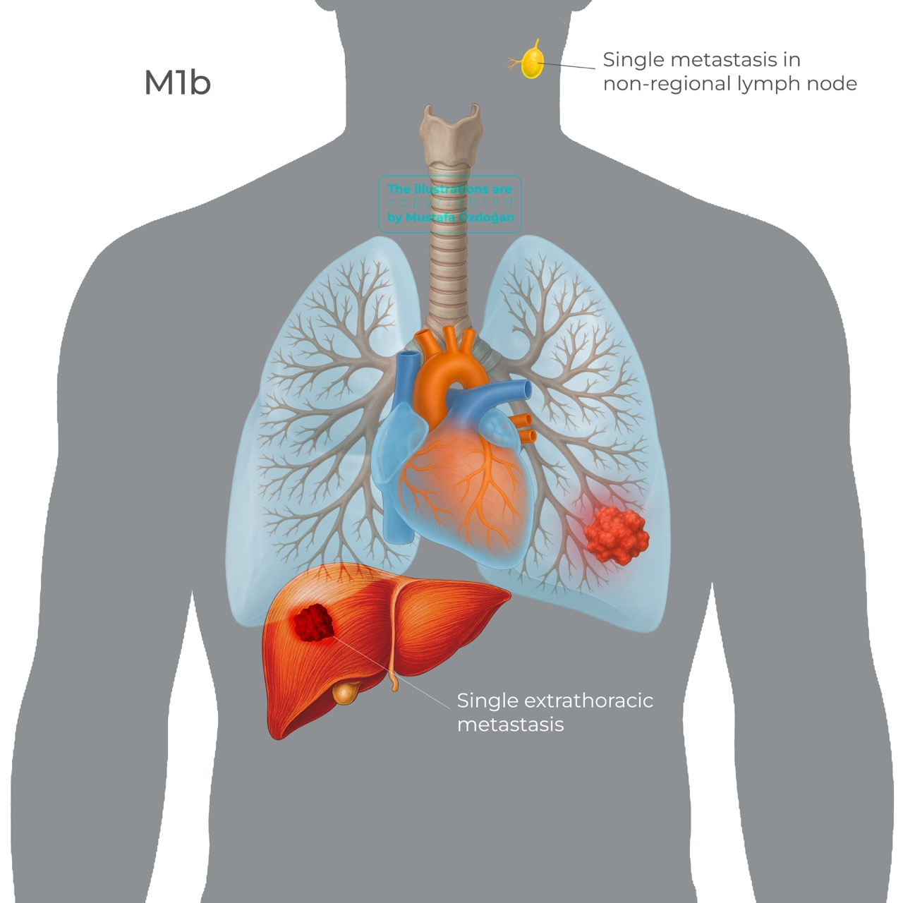 tnm9 lung cancer m1b 598527