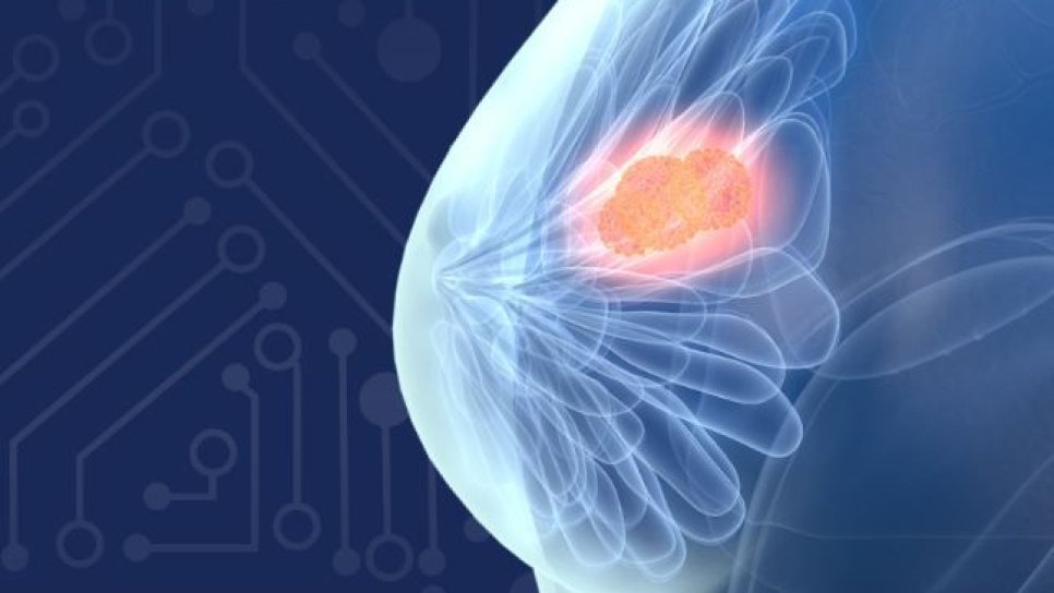 Dijital Meme Tomosentezi İçin Yapay Zeka Teknolojisi, FDA Onayı Aldı