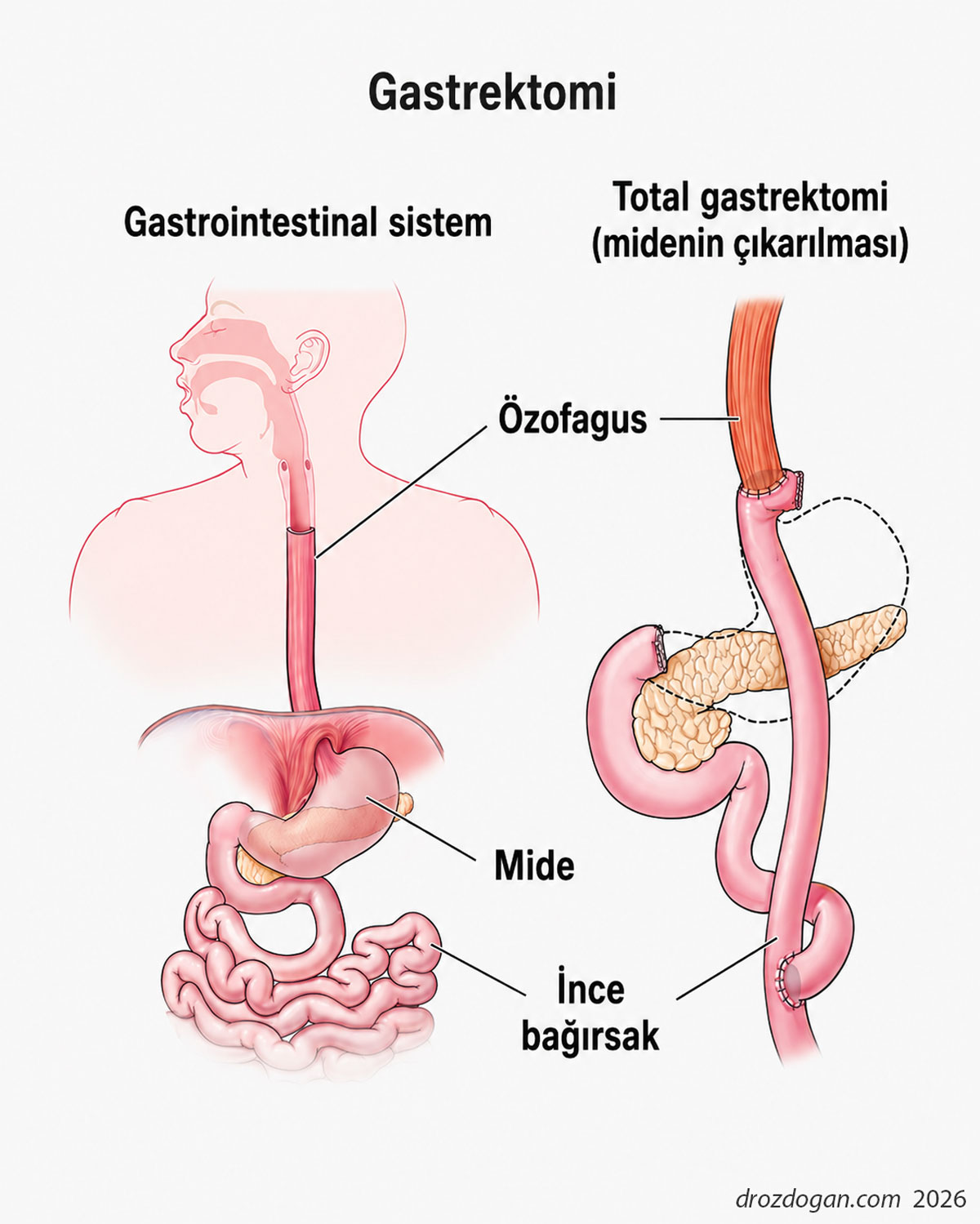 ce este gastrectomia totală, cum se efectuează, modificări anatomice chirurgicale, Prof. Dr. Mustafa Özdoğan