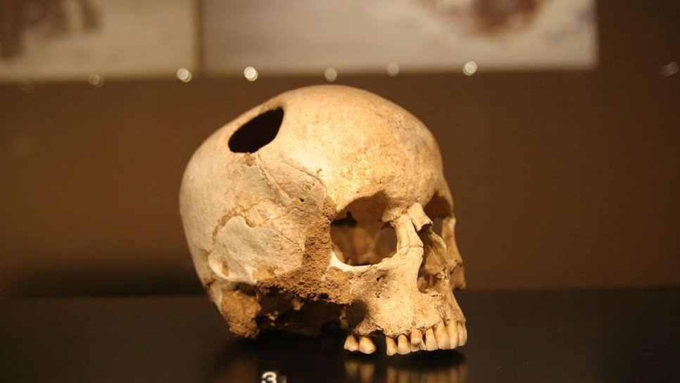 Trepanation 6500 v. Chr. – Wir beginnen zu schneiden und zu bohren