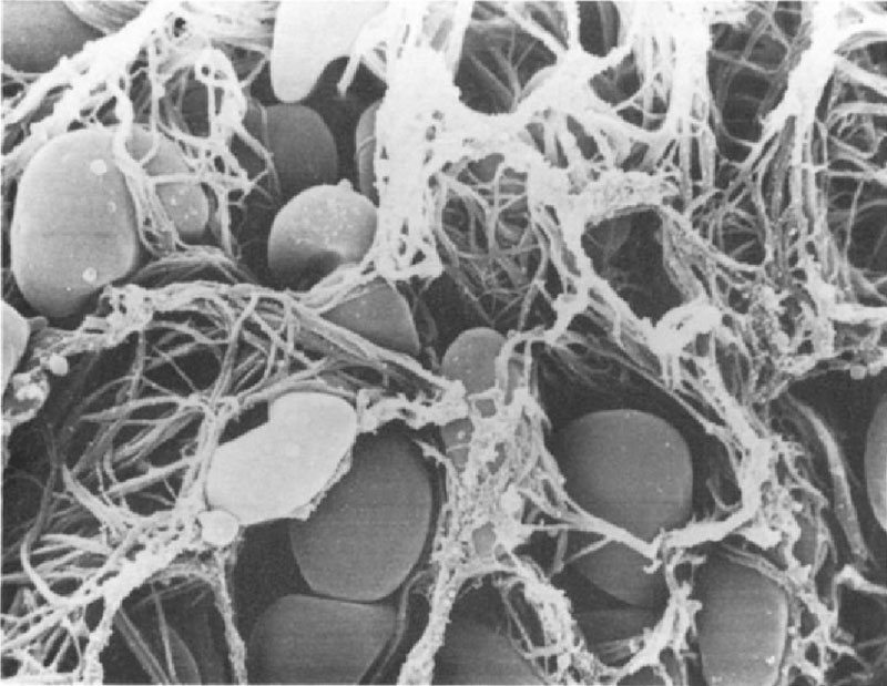 Rasterelektronenmikroskopische Aufnahme eines Thrombus