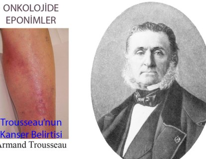 Trousseau Belirtisi Nedir? Adı Nereden Gelmektedir?