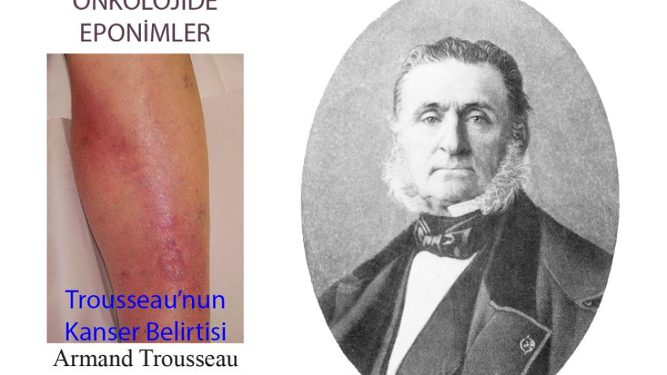 Trousseau Belirtisi Nedir? Adı Nereden Gelmektedir?