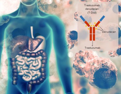 Tümör Agnostik (Bağımsız) Yeni Bir Kanser İlacı Fark Yaratıyor: Trastuzumab Deruxtecan