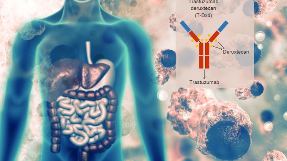 Tümör Agnostik (Bağımsız) Yeni Bir Kanser İlacı Fark Yaratıyor: Trastuzumab Deruxtecan