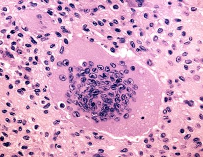Tenosinovyal Dev Hücreli Tümör Tedavisi İçin Pexidartinib FDA Onayı Aldı