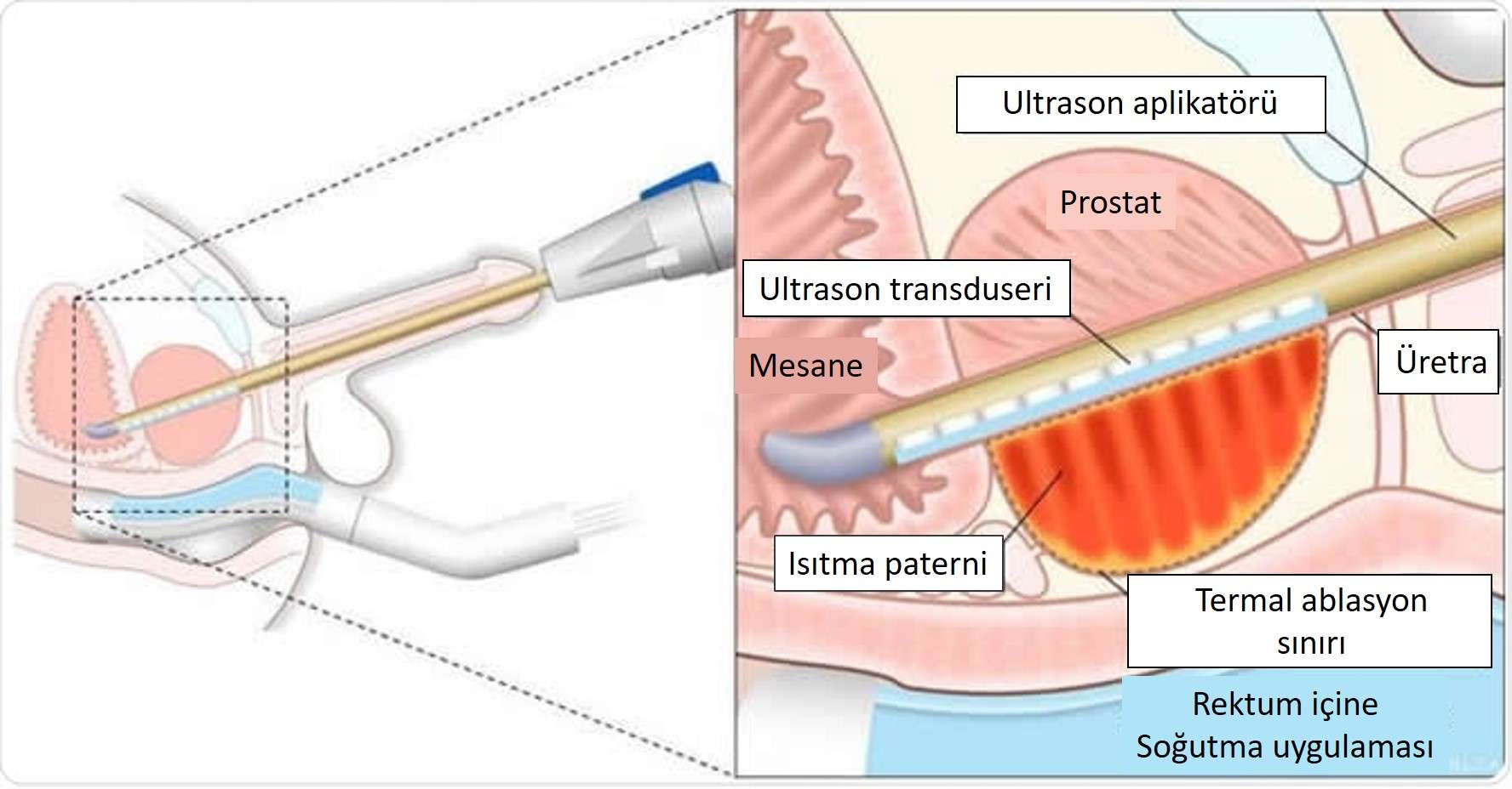 tusla ile prostat kanseri ablasyonu nasil calisir 607988