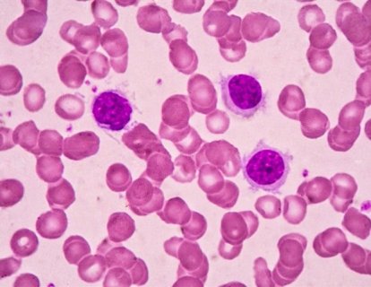 Tüylü Hücre Lösemi tedavisinde Moxetumomab Pasudotox-tdfk FDA onayı aldı