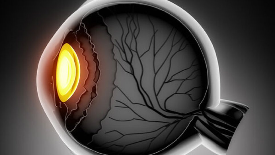Pembrolizumab plus Entinostat beim uvealen Melanom (Augenmelanom) und neue Entwicklungen