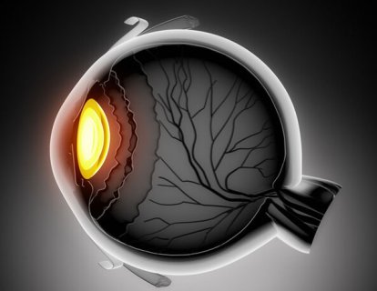 Uveal (göz) melanom için pembrolizumab artı entinostat ve son gelişmeler