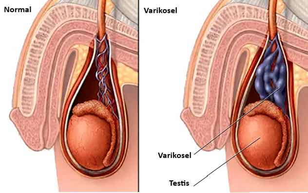 varikosel nedir 76917