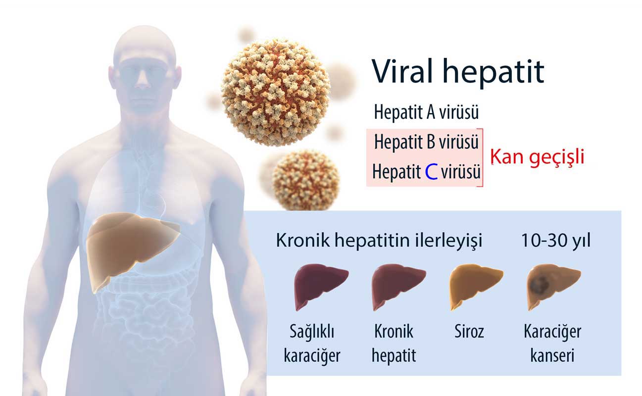 types of viral hepatitis a b c chronic cirrhosis liver cancer