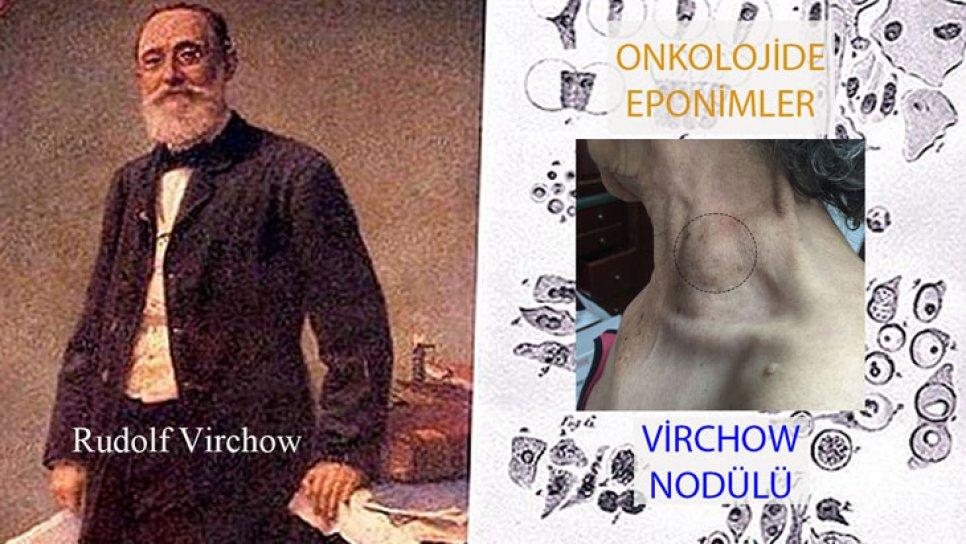 virchow nodülü nodu düğümü nedir adının tarihi