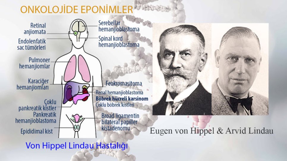 Von Hippel-Lindau Hastalığı Nedir? Adı Nereden Gelmektedir?