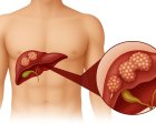 Y-90 Mikroküre (TARE) Tedavisi Ameliyata Uygun Olmayan Karaciğer Kanserinde FDA Onayı Aldı