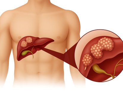 Y-90 Mikroküre (TARE) Tedavisi Ameliyata Uygun Olmayan Karaciğer Kanserinde FDA Onayı Aldı